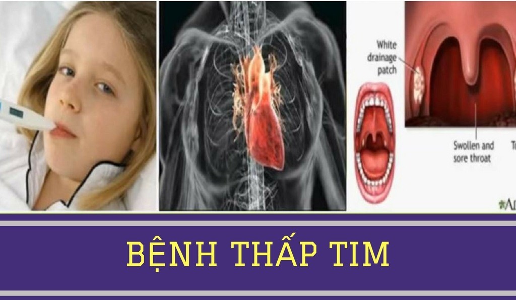 BỆNH THẤP TIM (ARF) VÀ CÁCH PHÒNG