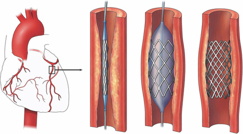 Diagnosis and treatment of acute appendicitis: 2020 update of the WSES Jerusalem guidelines