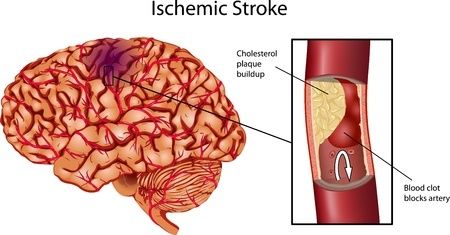 Bệnh nhồi máu não cấp: Nguyên nhân, dấu hiệu nhận biết và cách phòng chống bệnh