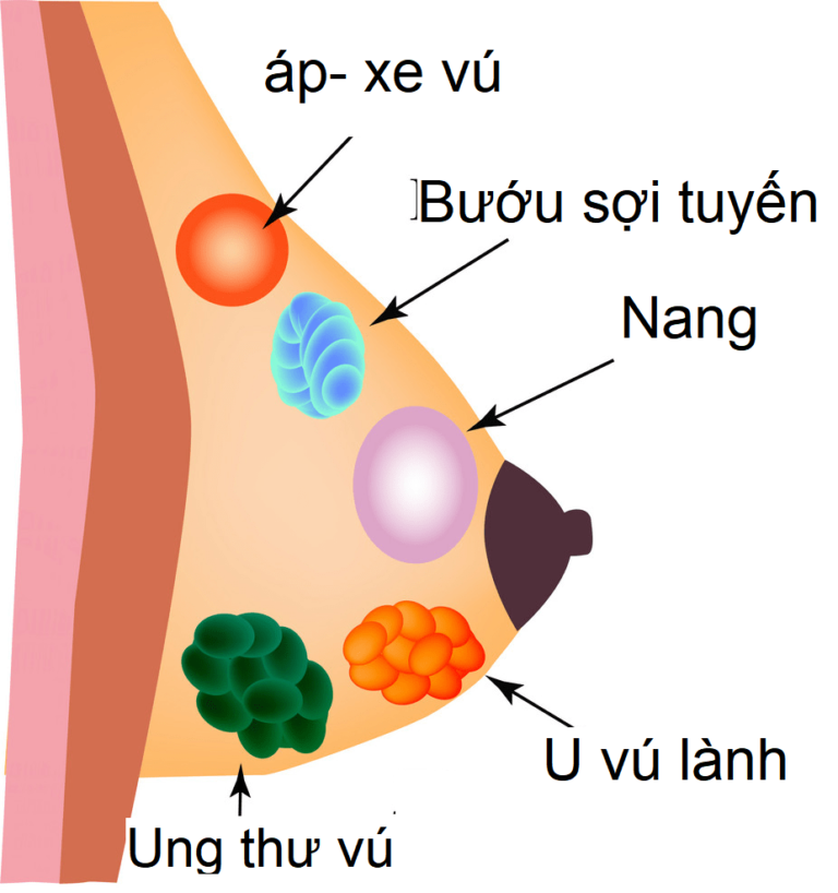 KHỐI U VÚ: Nguyên nhân và phát hiện khối u vùng vú